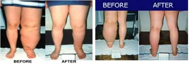 LYMPHEDEMA - Total Compression