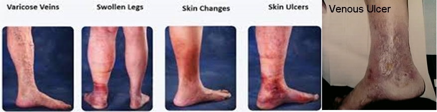 CHRONIC VENOUS INSUFFICIENCY- CVI - Total Compression