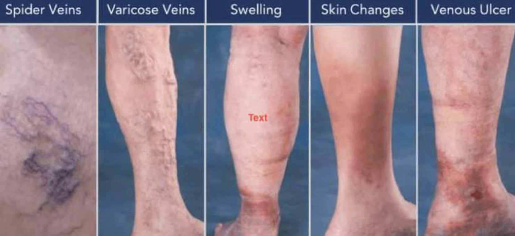 Chronic Venous Insufficiency  Compression therapy Treatment